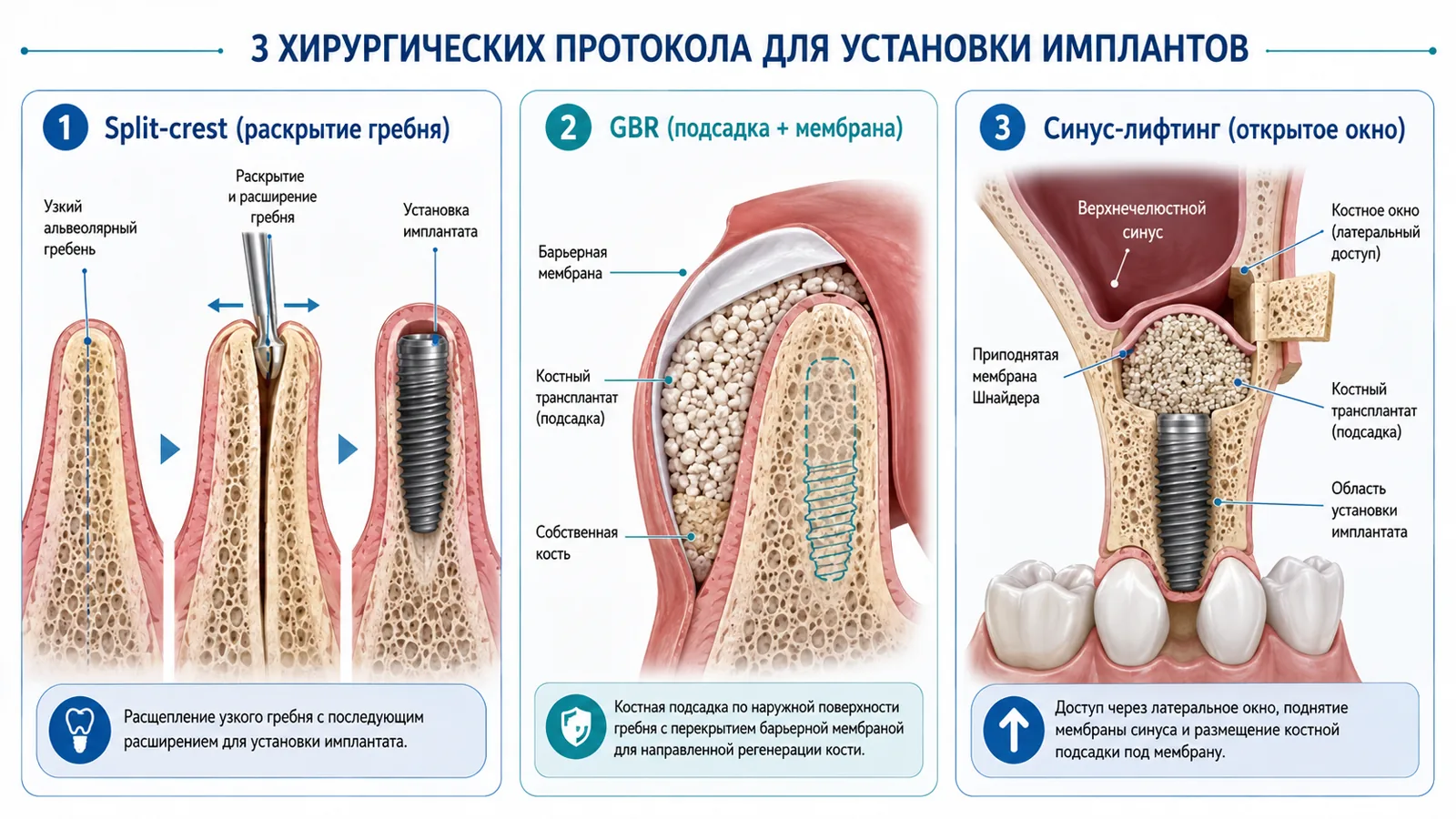 Схема трёх протоколов костной пластики: расщепление гребня, GBR с мембраной, синус-лифтинг