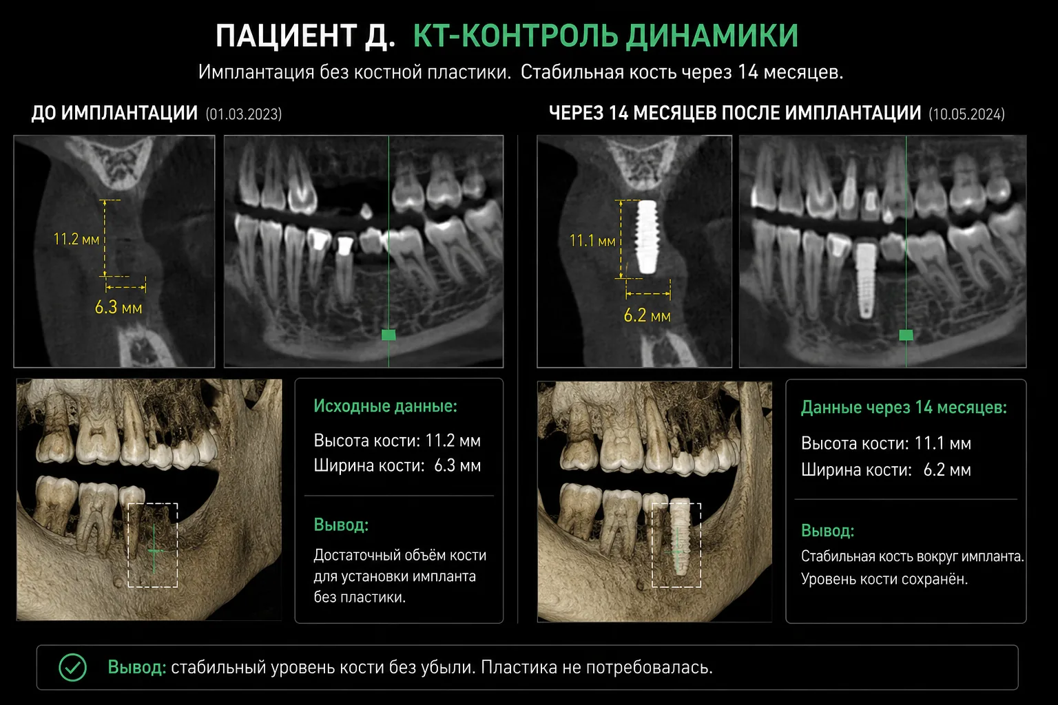 КТ-снимки пациента Д. — до имплантации и через 14 месяцев после
