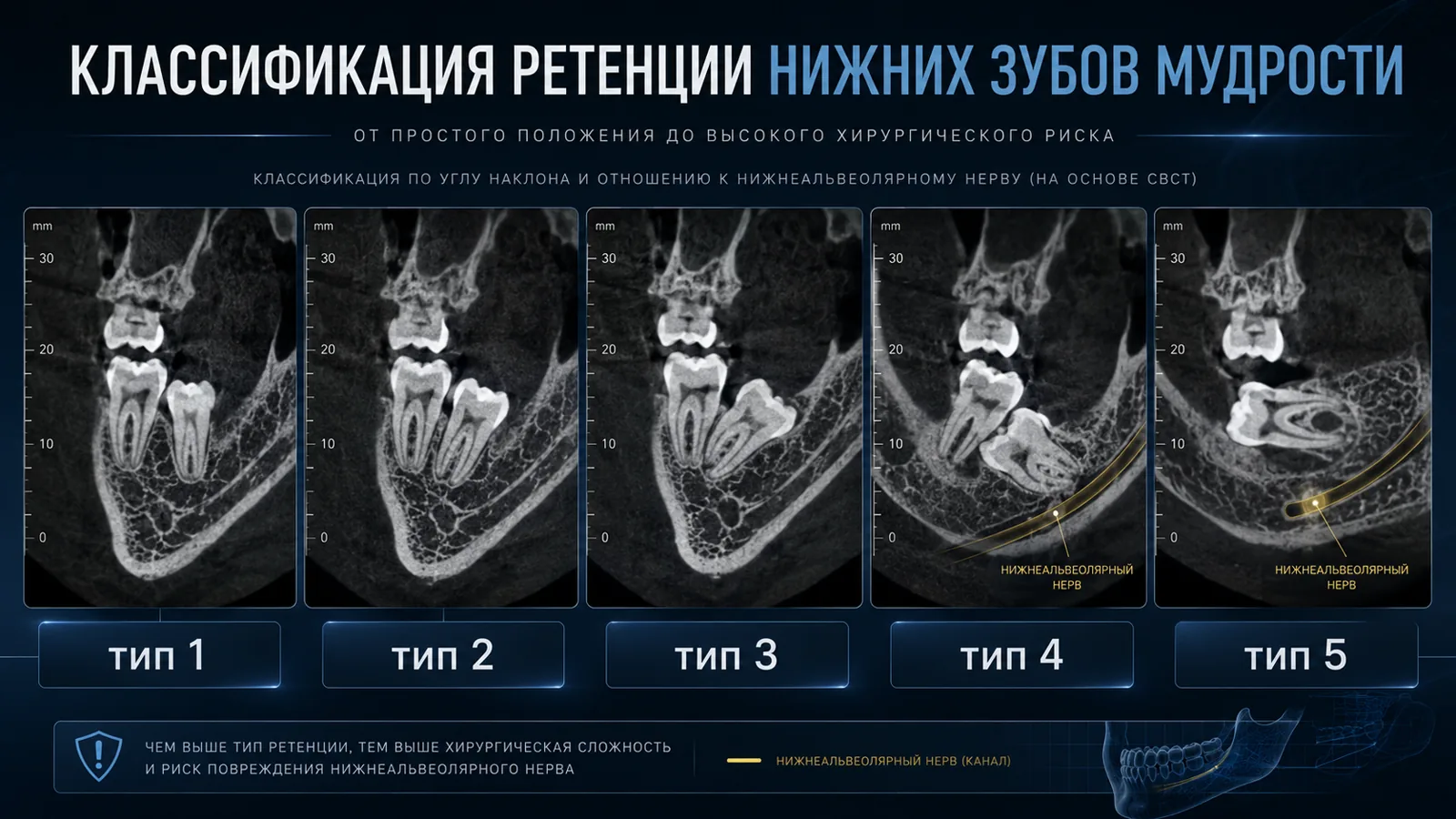 КТ-снимки 5 типов положения зубов мудрости — от вертикального до полностью горизонтального